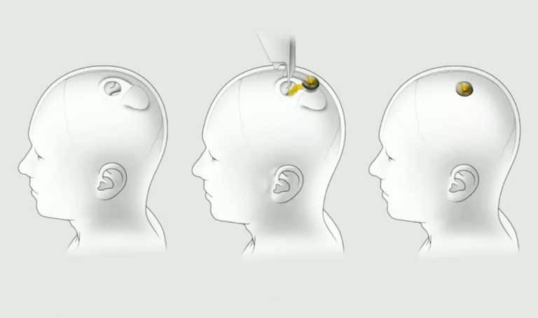 Elon Musk says Smartwatches & phones are yesterday’s technology, Neuralinks are the future