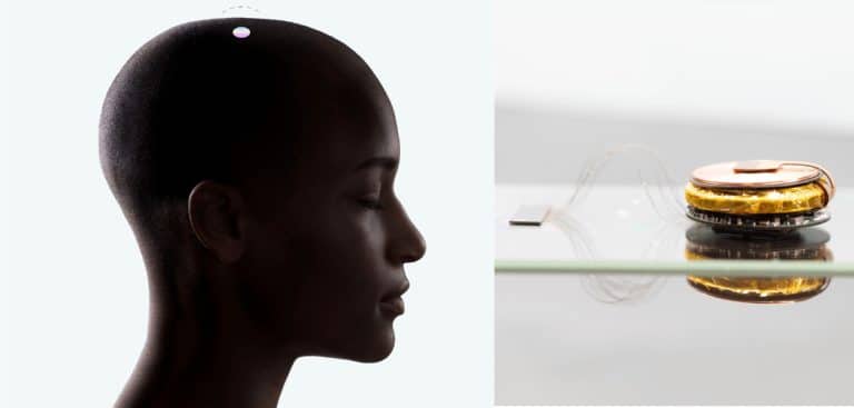 Elon Musk’s Optimism and Breakthroughs in Neuralink’s Human Trials